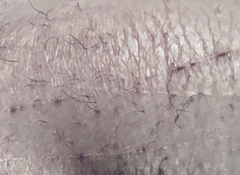 bird mite bite mark lesions on human leg